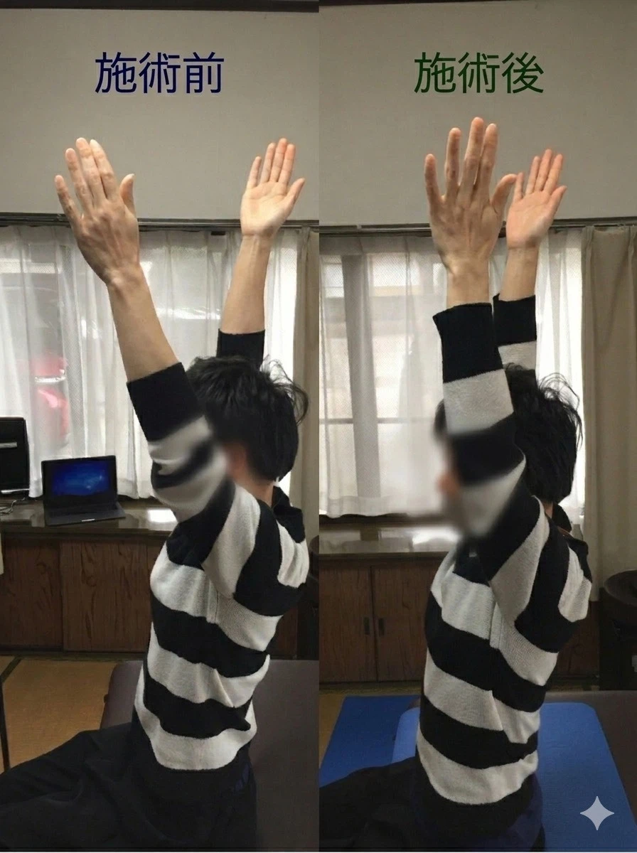 左肩の痛み 施術前後