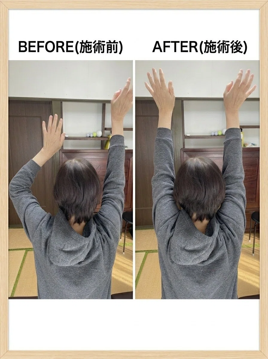 左肩の痛み（約半年）施術前後