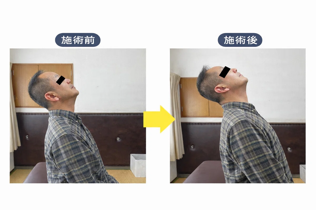 首の痛み 施術前後