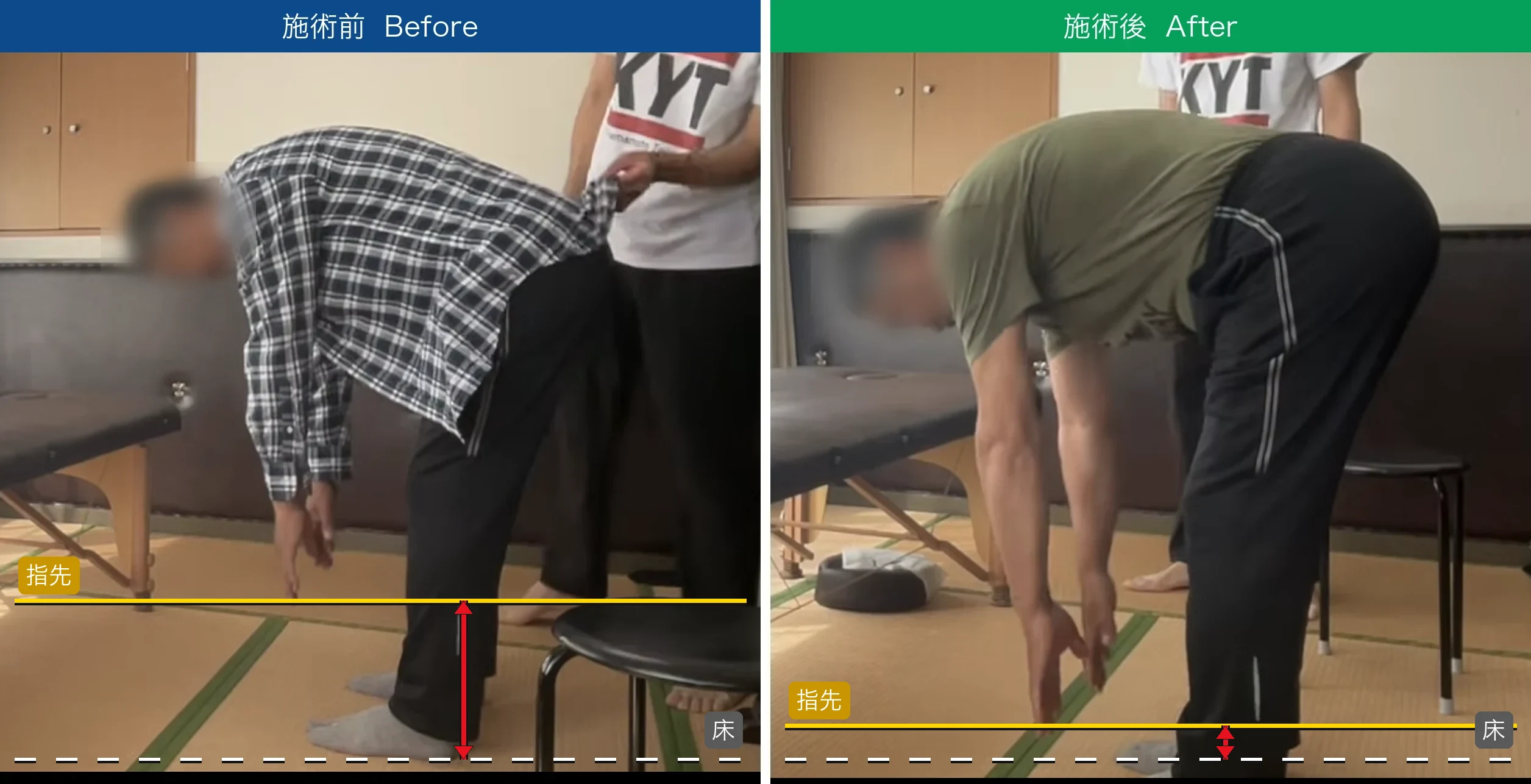 腰痛・前屈時の可動域 施術前後